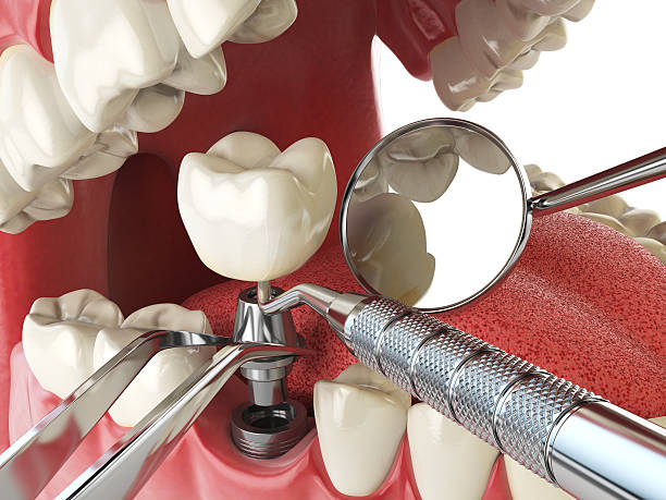 Best Broken or Cracked Tooth Emergency Dentist in Glasgow, VA